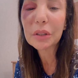 Ivete Sangalo fez uma operação por conta da fratura no rosto