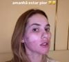 Virgínia Fonseca realizou um laser no rosto para acabar com as manchas de acne que a deixou vermelha