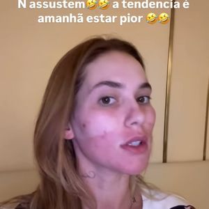 Virgínia Fonseca realizou um laser no rosto para acabar com as manchas de acne que a deixou vermelha