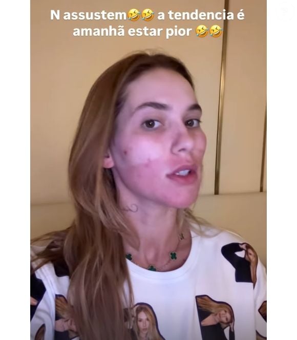 Virgínia Fonseca realizou um laser no rosto para acabar com as manchas de acne que a deixou vermelha