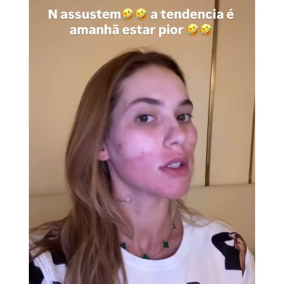 Virgínia Fonseca realizou um laser no rosto para acabar com as manchas de acne que a deixou vermelha