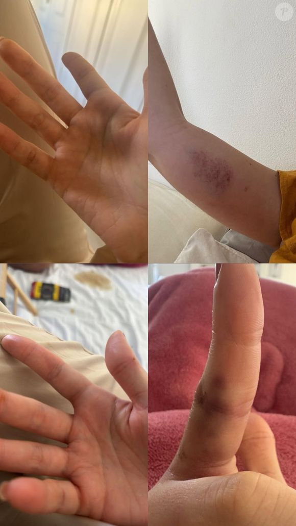 Namorada de Dado Dolabella, Marcela Tomaszewski enviou fotos com marcas de machucado e atribuiu agressões ao ator