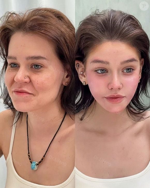 Esta outra paciente do Dr. Lifeng também ficou com traços asiáticos