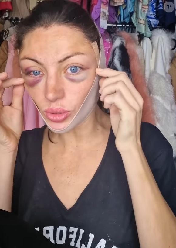 Bárbara Jankavski foi encontrada com marca no olho esquerdo - segundo amigo de defensor público, a Barbie Humana sofreu uma queda na casa dele - na foto, influencer após procedimento estético