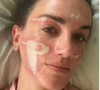 'Experiência bem traumática': mulher acusa esteticista de Madonna, Kim Kardashian e mais famosas de grave queimadura no rosto após peeling químico