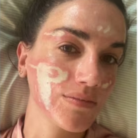 'Experiência bem traumática': mulher acusa esteticista de Madonna, Kim Kardashian e mais famosas de grave queimadura no rosto após peeling químico