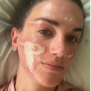 'Experiência bem traumática': mulher acusa esteticista de Madonna, Kim Kardashian e mais famosas de grave queimadura no rosto após peeling químico