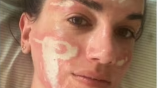 'Experiência bem traumática': mulher acusa esteticista de Madonna, Kim Kardashian e mais famosas de grave queimadura no rosto após peeling químico
