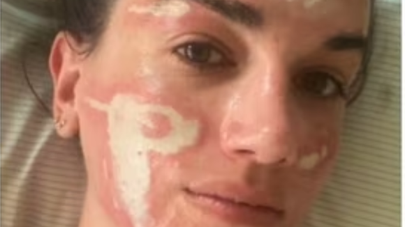 'Experiência bem traumática': mulher acusa esteticista de Madonna, Kim Kardashian e mais famosas de grave queimadura no rosto após peeling químico