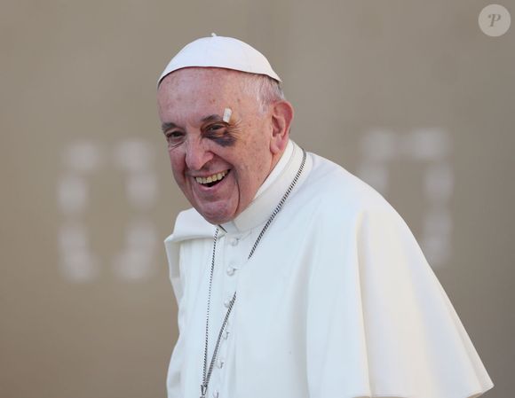 2017: Papa Francisco, após uma viagem para a Colômbia, deixou todos preocupados ao aparecer com o olho roxo