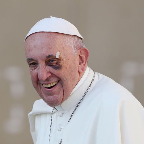 2017: Papa Francisco, após uma viagem para a Colômbia, deixou todos preocupados ao aparecer com o olho roxo