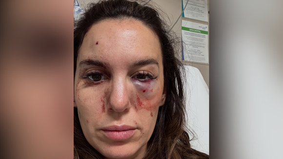 O drama da estrela da Disney que teve o rosto baleado no aniversário do marido: ‘A 1 milímetro de me deixar cega’