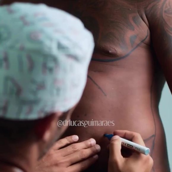 Davi Brito foi submetido a uma lipo LAD, queridinha de famosas como Gkay e Virgínia Fonseca