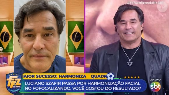 O ator fez uma harmonização facial bem discreta, que preservou sua aparência natural
