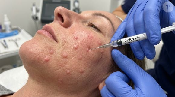 O PDRN, conhecido popularmente como "esperma de salmão", ganhou espaço na cosmética coreana após anos de uso na medicina regenerativa, especialmente em processos de cicatrização e reparação dos tecidos. O ingrediente é formado por fragmentos de DNA altamente purificados e tem potencial para favorecer a regeneração celular, modular a inflamação e melhorar a qualidade da pele