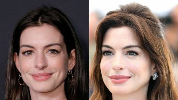 O 'segredo' de Anne Hathaway: por que o caso da atriz de 'O Diabo Veste Prada' revela cirurgias plásticas 'invisíveis' como tendência? Cirurgião explica