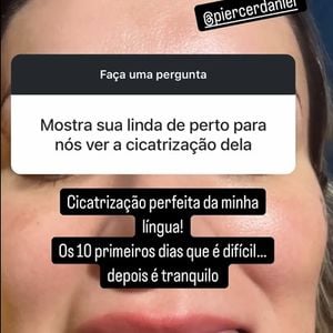 Antes e depois de Andressa Urach: modelo, em 2024, passou por uma cirurgia de bifurcação na língua.