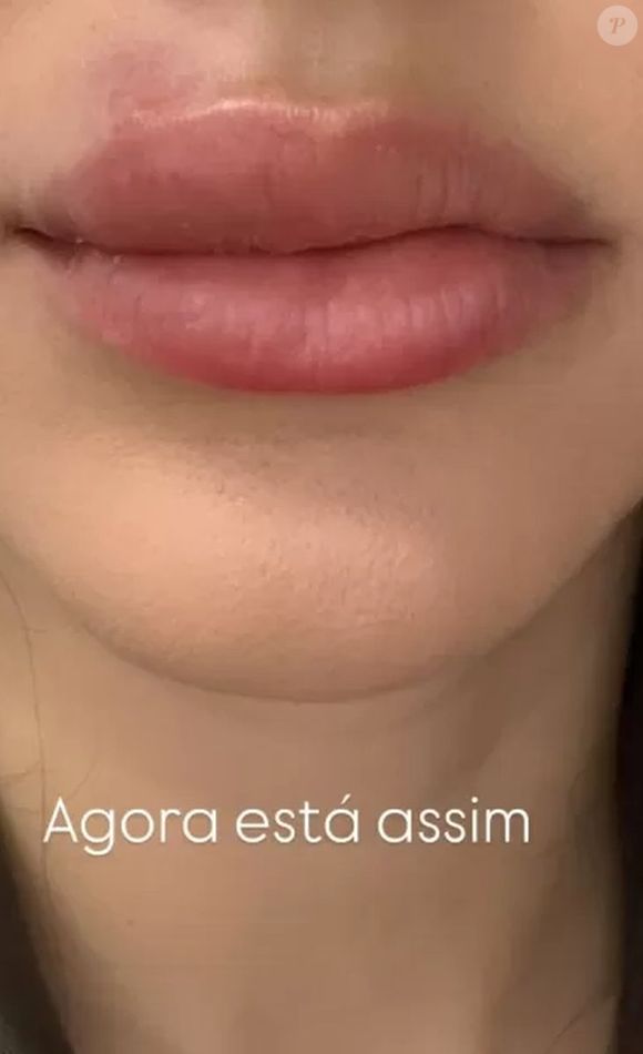 Bruna Biancardi ainda está com a boca bastante inchada após ter espremido uma espinha