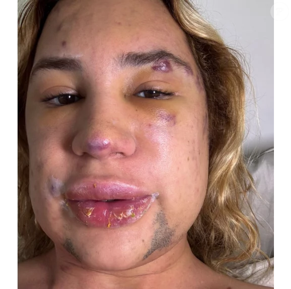 Junior Dutra sofreu com dor e inflamação após o procedimento e chegou a procurar o profissional responsável, mas disse não ter recebido o suporte necessário