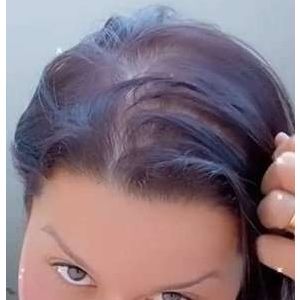 Maraisa é outra famosa que sofre de alopecia