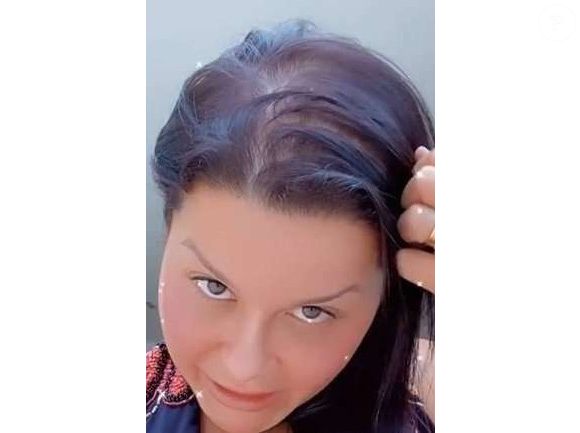 Maraisa é outra famosa que sofre de alopecia