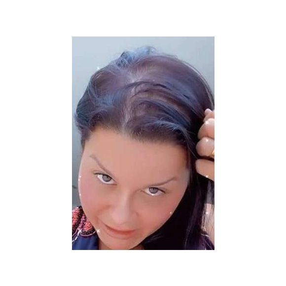 Maraisa é outra famosa que sofre de alopecia