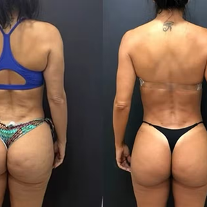 Carla Prata reduziu seu percentual de gordura após fazer um tratamento adequado contra o lipedema