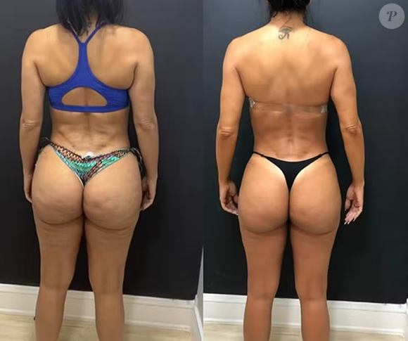 Carla Prata reduziu seu percentual de gordura após fazer um tratamento adequado contra o lipedema