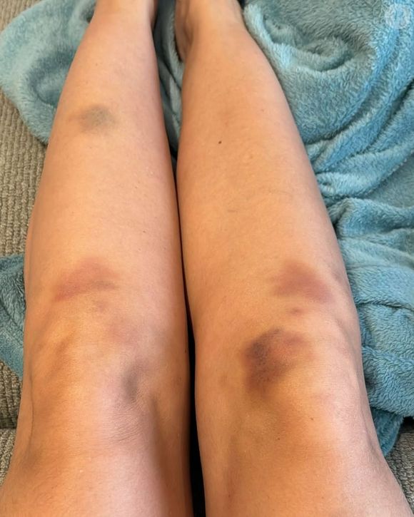 Lipedema também causa inchaço nas pernas, dores e roxidão, como mostrado nesta foto por Yasmin Brunet