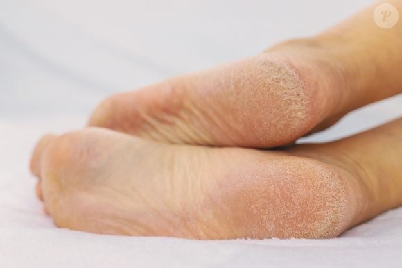 Dermatologista recomenda hidratação noturna e oclusão para tratar calcanhares secos e endurecidos