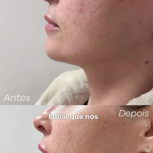 Ana Paula Renault também fez um preenchimento labial no ano passado, que ficou com uma aparência sutil e muito natural