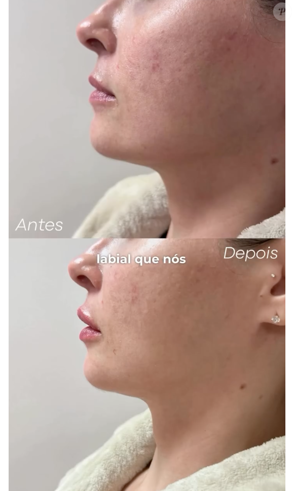 Ana Paula Renault também fez um preenchimento labial no ano passado, que ficou com uma aparência sutil e muito natural