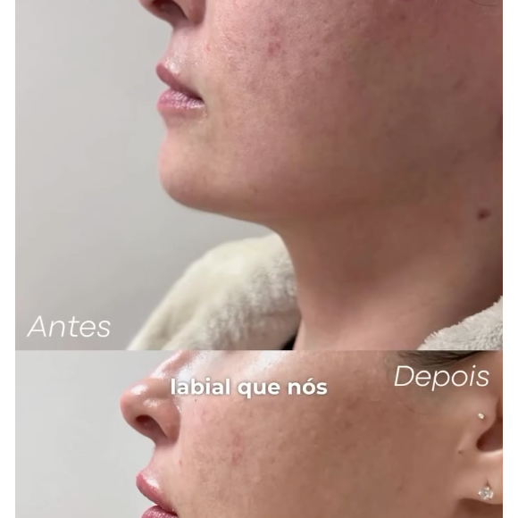 Ana Paula Renault também fez um preenchimento labial no ano passado, que ficou com uma aparência sutil e muito natural
