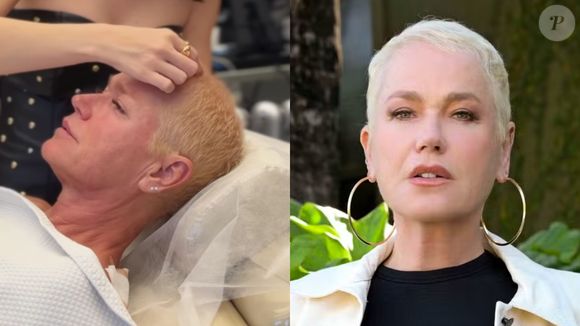 Xuxa recorreu ao transplante capilar nos últimos meses para lidar com a alopecia androgenética