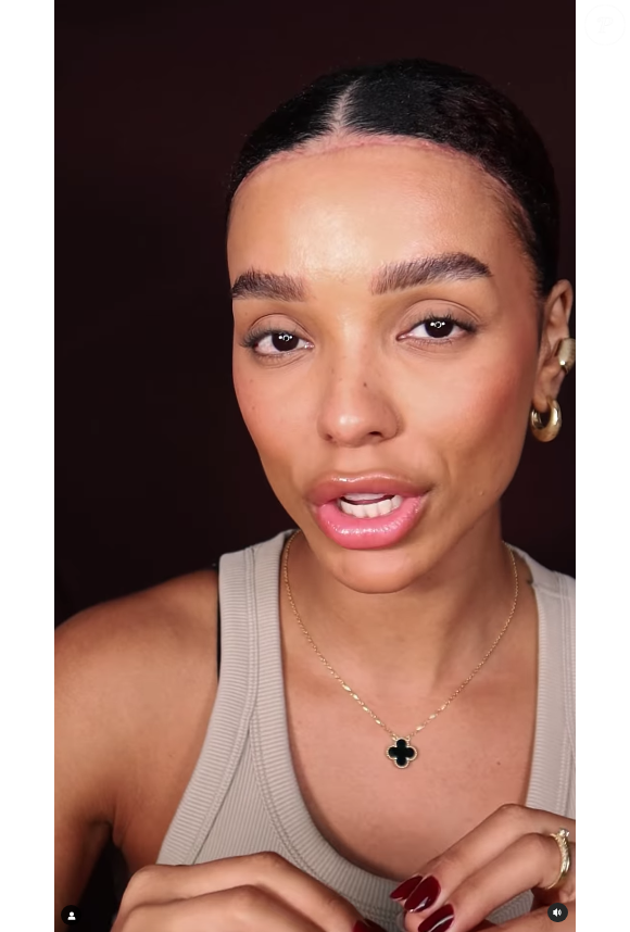 Brunna Gonçalves mostrou a cicatriz de sua cirurgia na web