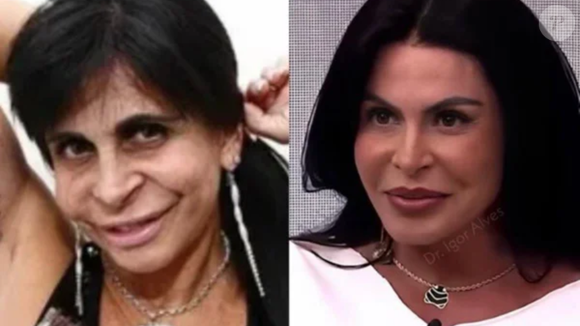 Antes e depois do 'novo rosto' de Gretchen viraliza e cantora rebate críticas de mulheres: “Recalcadas e frustradas”