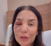 Ivete Sangalo atualiza estado de saúde após quebrar dois ossos do rosto durante queda provocada por síndrome vasovagal