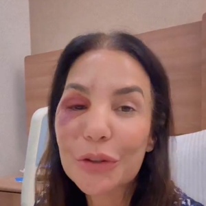 Ivete Sangalo atualiza estado de saúde após quebrar dois ossos do rosto durante queda provocada por síndrome vasovagal