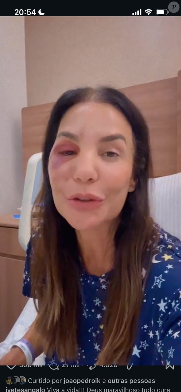 Ivete Sangalo atualiza estado de saúde após quebrar dois ossos do rosto durante queda provocada por síndrome vasovagal