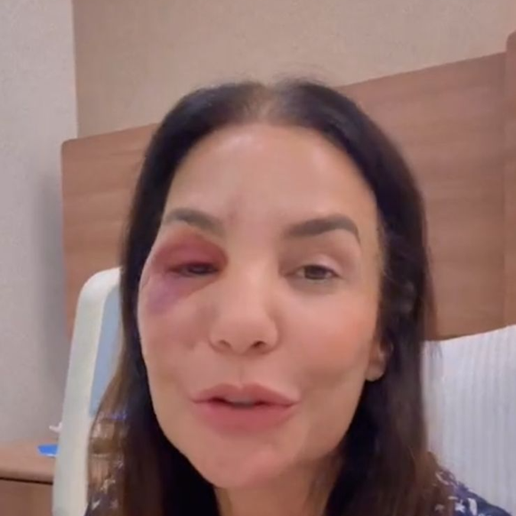 Ivete Sangalo atualiza estado de saúde após quebrar dois ossos do rosto durante queda provocada por síndrome vasovagal
