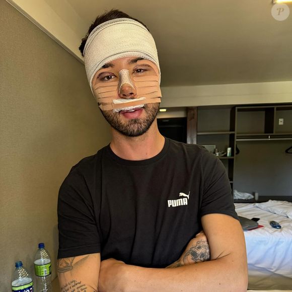 Rico Melquiades fez uma rinoplastia combinada com uma cirurgia de 'fox eyes'