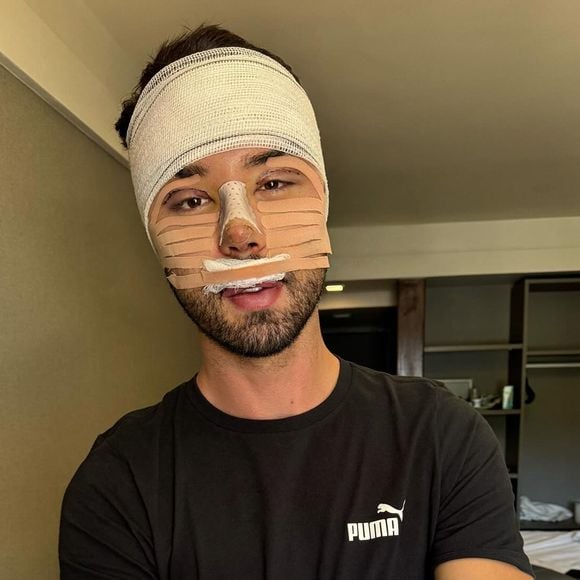 Rico Melquiades fez uma rinoplastia combinada com uma cirurgia de 'fox eyes'