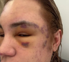 Depois do procedimento, o influenciador relatou sentir dor e inflamação: “Assim que eu fiz o procedimento, eu senti como se fosse uma veia estourada do lado esquerdo do rosto. Do lado direito estava tudo ok, mas no esquerdo eu sentia expulsando o fio”.