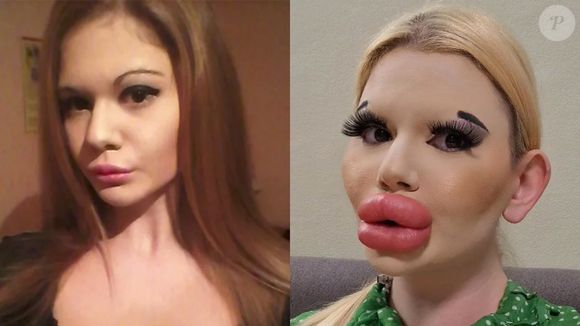 Antes e depois de Andrea Ivanova: conhecida como a mulher com os maiores lábios do mundo, sua aparência hoje é bizarra