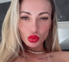 No procedimento, Andressa Urach aplicou 12 ml de ácido hialurônico na região e, por isso, deve deixar a área de repouso