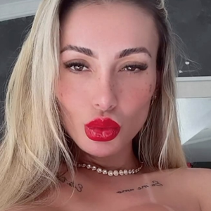 No procedimento, Andressa Urach aplicou 12 ml de ácido hialurônico na região e, por isso, deve deixar a área de repouso