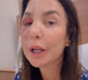 Ivete Sangalo surge com o rosto inchado após cirurgia para corrigir fratura no osso zigomático, causada por queda após desmaio