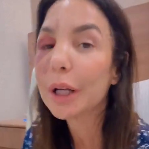 Ivete Sangalo surge com o rosto inchado após cirurgia para corrigir fratura no osso zigomático, causada por queda após desmaio