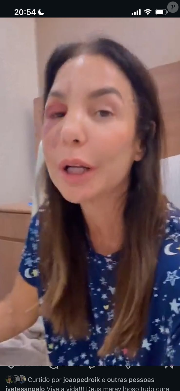 Ivete Sangalo surge com o rosto inchado após cirurgia para corrigir fratura no osso zigomático, causada por queda após desmaio