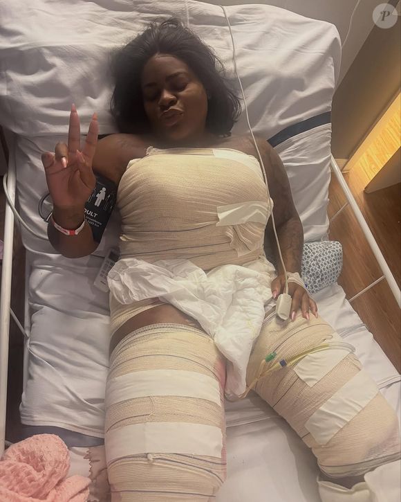 Jojo Todynho realizou mais um combo de cirurgias plásticas após emagrecer 80 kg